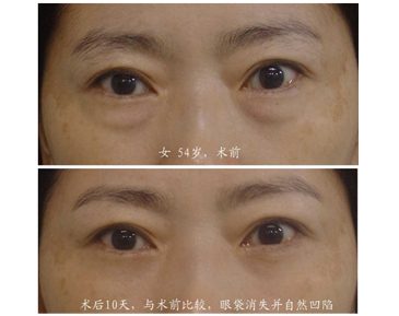 激光去眼袋的效果
