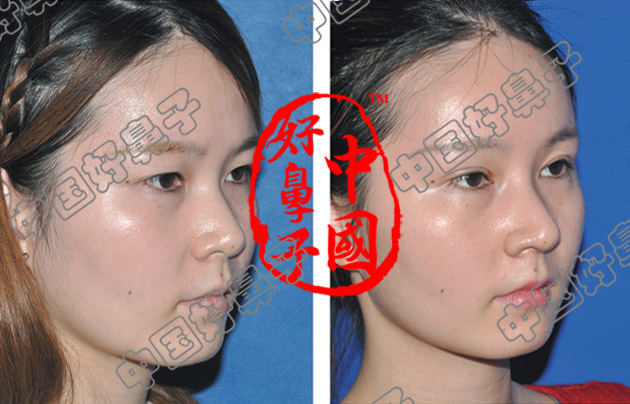 隆鼻术加双眼皮