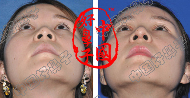 隆鼻术加双眼皮