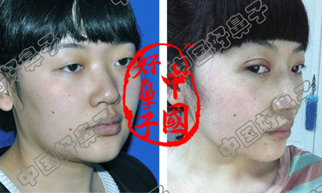 隆鼻术加双眼皮