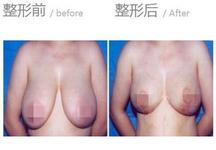 乳头缩小整形多少钱