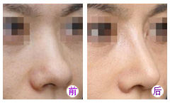 注射隆鼻要多少钱