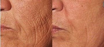 口角纹怎样去除