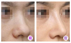 玻尿酸隆鼻需要多少费用