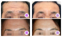 有抬头纹怎么办