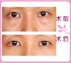 热玛吉可以去眼袋吗