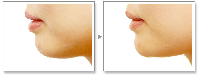 注射隆下巴多少钱