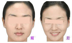 改变脸型得用多少钱