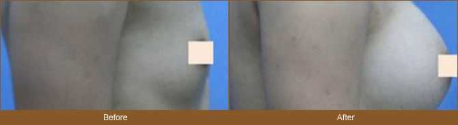 假体丰胸影响怀孕哺乳吗