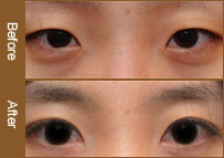 做双眼皮需要多少费用