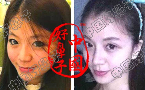 鼻子先天性塌陷怎么办