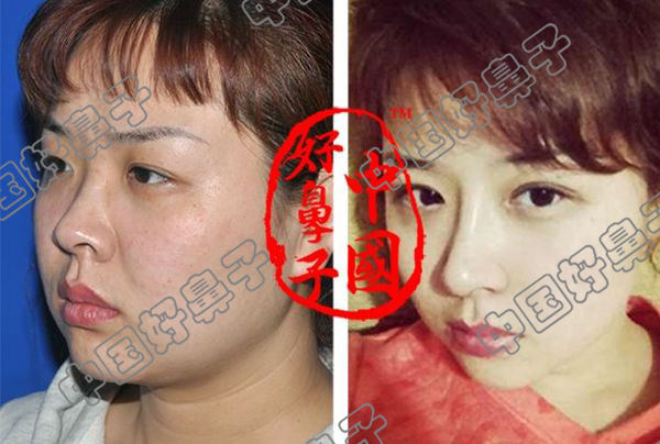 光纤溶脂可以瘦脸吗