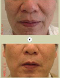 做鼻唇沟法令纹多少钱