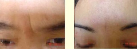 切眉手术多少钱