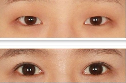 什么样的眼睛适合开眼角