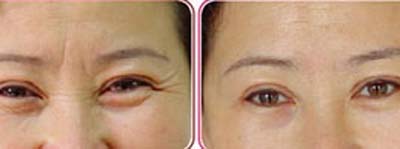 怎样去除眼角皱纹