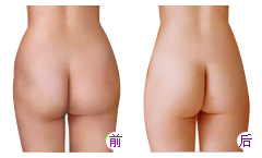 自体脂肪移植多少钱