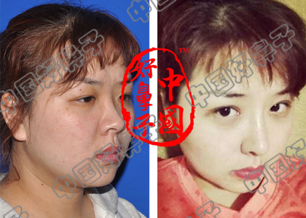 做双眼皮多少钱