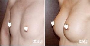 可以给男士丰胸吗