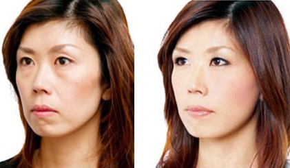 自体脂肪填充能成活吗