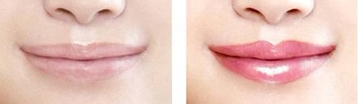 注射爱贝芙丰唇嘴唇会肿吗