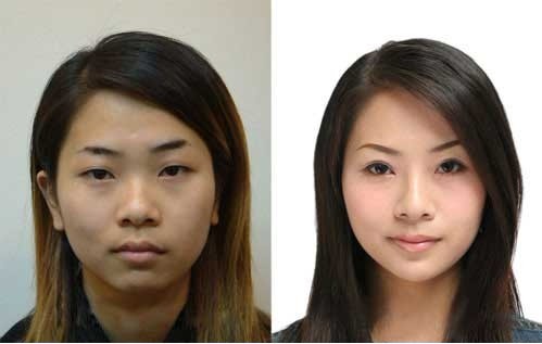 韩式双眼皮手术