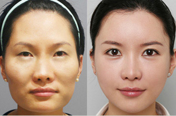 开眼角手术效果好不好