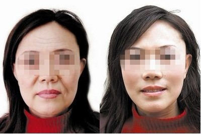 法令纹消除需要多少钱