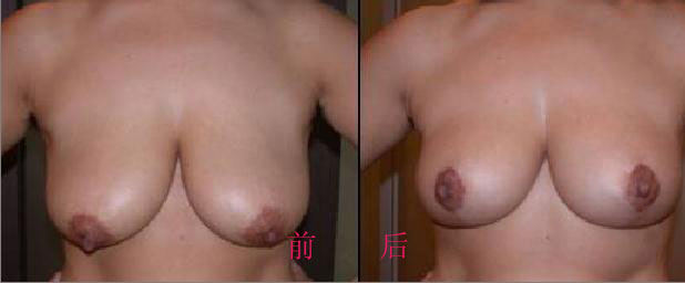 做缩胸手术多少钱