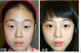 做永久双眼皮是怎么收费的