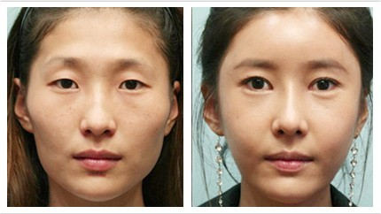 韩式双眼皮手术多久恢复