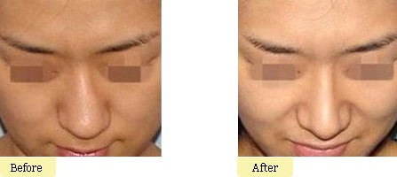 歪鼻整形手术的优势及适用人群