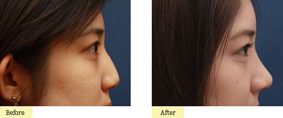 假体隆鼻手术项目