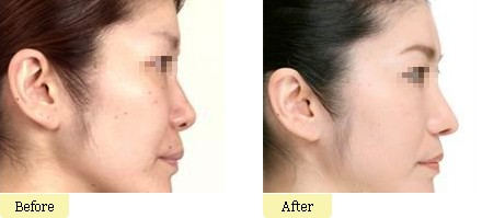 注射隆鼻术优势及恢复时间