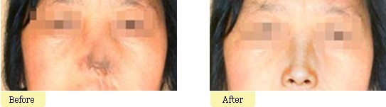 全鼻再造手术优势