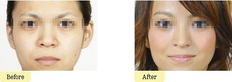 宽鼻缩窄整形手术