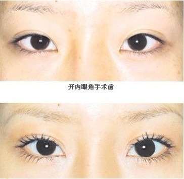 开眼角手术有没有副作用