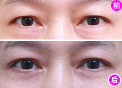 激光去眼袋需要注意哪些问题