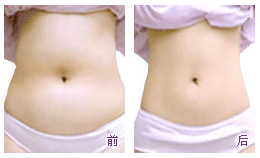 腰部吸脂减肥安全性如何