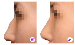 做隆鼻手术不满意想取出假体费用是多少