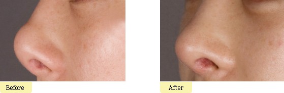 自体软骨隆鼻优点是什么