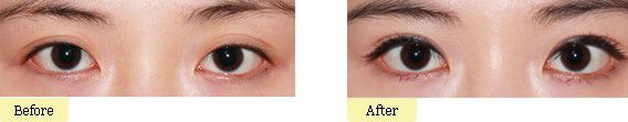 开眼角失败能修复吗