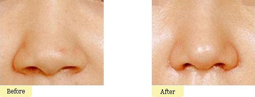 韩式假体隆鼻多少钱