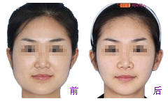 玻尿酸丰脸颊有何优点