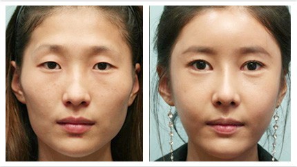 割双眼皮的效果好吗