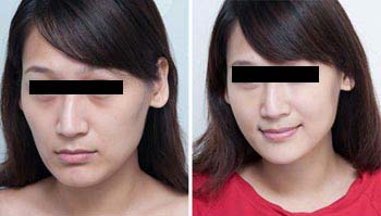 玻尿酸注射丰面颊会不会有副作用