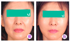 玻尿酸丰下巴有什么优点