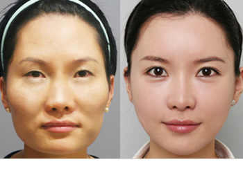 玻尿酸丰太阳穴后应该怎么护理