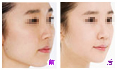 注射瘦脸针对身体有副作用吗