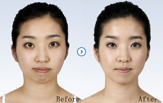 伊维兰丰太阳穴多少钱